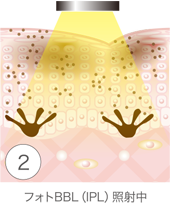 フォトBBL（IPL）の施術効果