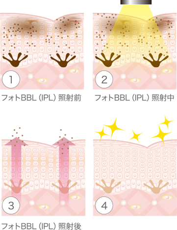 フォトBBL（IPL）の施術効果